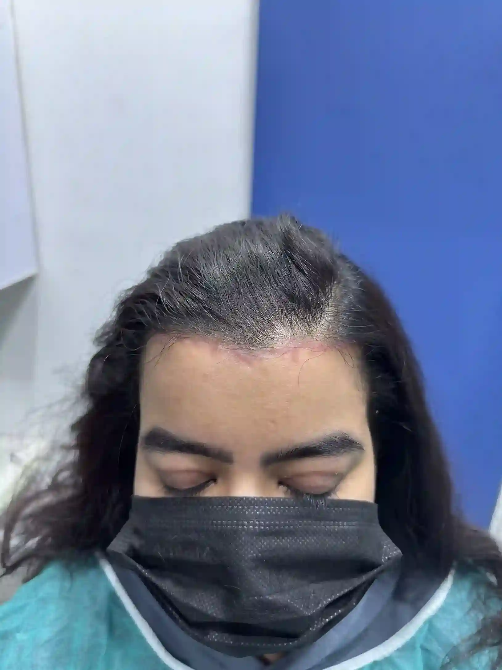 PRP Hairfall Treatment