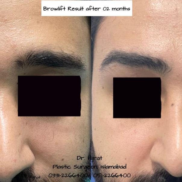 Brow / Forehead Lift