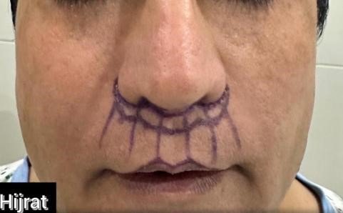Subnasal Lip Lift