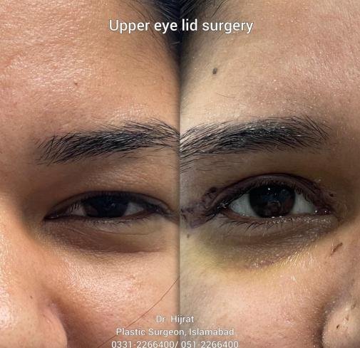 Eyelid Surgery