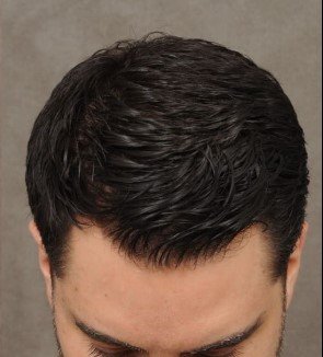 Hair Transplant