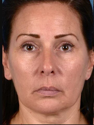 Laser Treatment